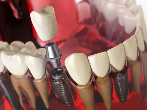 Jakie są efekty uboczne implantacji stomatologicznej?